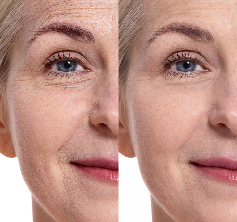 Das gleiche Frauengesicht nebeneinander: Links mit mehr Falten auf der Stirn, rechts mit weniger Falten