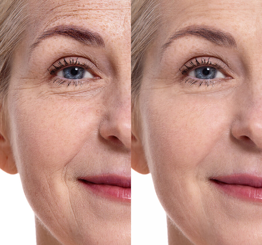 Das gleiche Frauengesicht nebeneinander: Links mit mehr Falten auf der Stirn, rechts mit weniger Falten